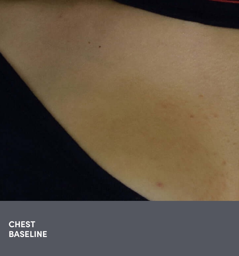 16 year old teen female chest acne photo before AKLIEF® (trifarotene) Cream prescription acne treatment