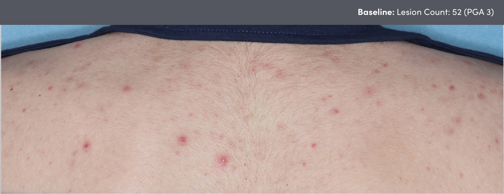 Photo of truncal acne vulgaris before AKLIEF® (trifarotene) Cream acne vulgaris medication